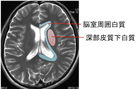 脳MRIの慢性虚血性変化とは？イラストと画像でわかりやすく解説！